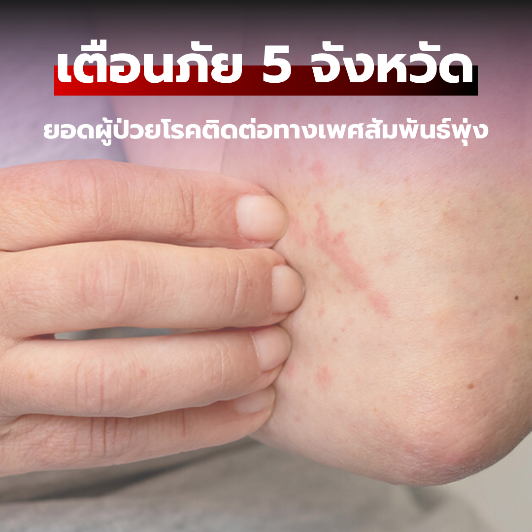 เตือนภัย 5 จังหวัดยอดผู้ป่วยโรคติดต่อทางเพศสัมพันธ์พุ่ง