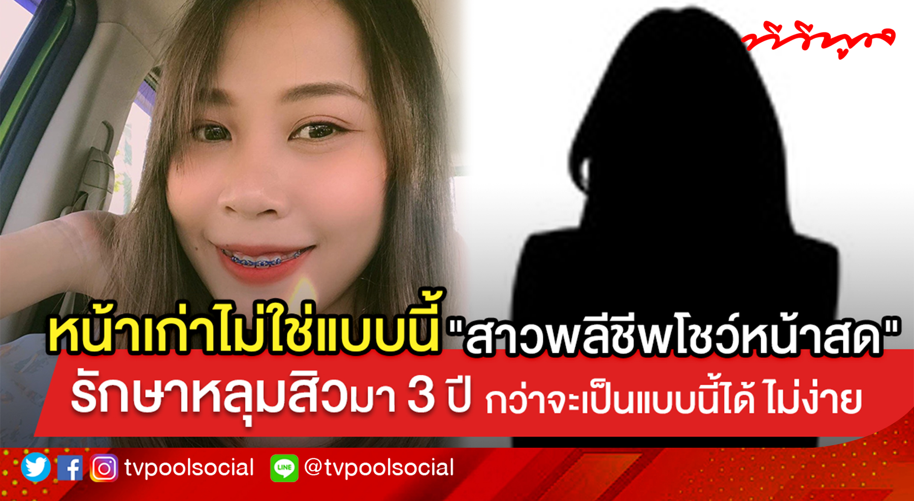 สาวใจกล้ายอมรีวิวพลีชีพ เผยหน้าสด เป็นหลุมสิวเรื้อรังนาน 3 ปี กว่าจะหายได้ ไม่ง่ายอย่างที่คิด